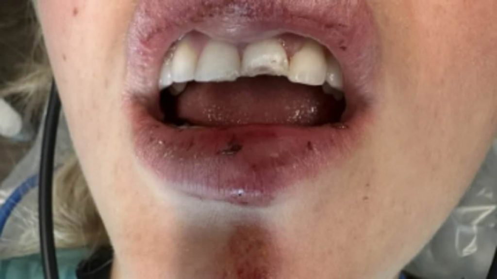 Utah bride-to-be suffers chipped tooth and bruised face day before her wedding after flying off back of truck - Daily Mail